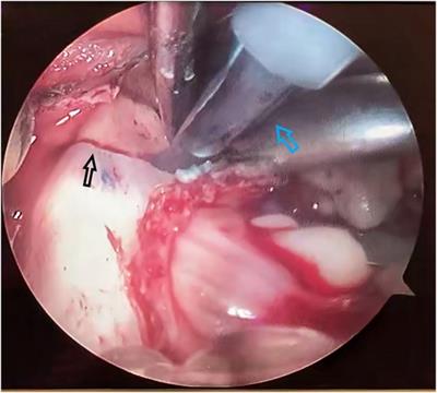 Piezosurgery in hemifacial microsomia: a promising exemption from conventional peri-osteotomy suffering